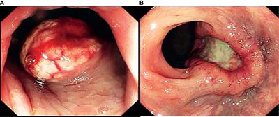 Tumor Macroscopic Morphology Is an Important Prognostic Factor in Predicting Chemotherapeutic Efficacy and Clinical Outcomes of Patients With Colorectal Neuroendocrine Neoplasms, One Multicenter Retrospective Cohort Study